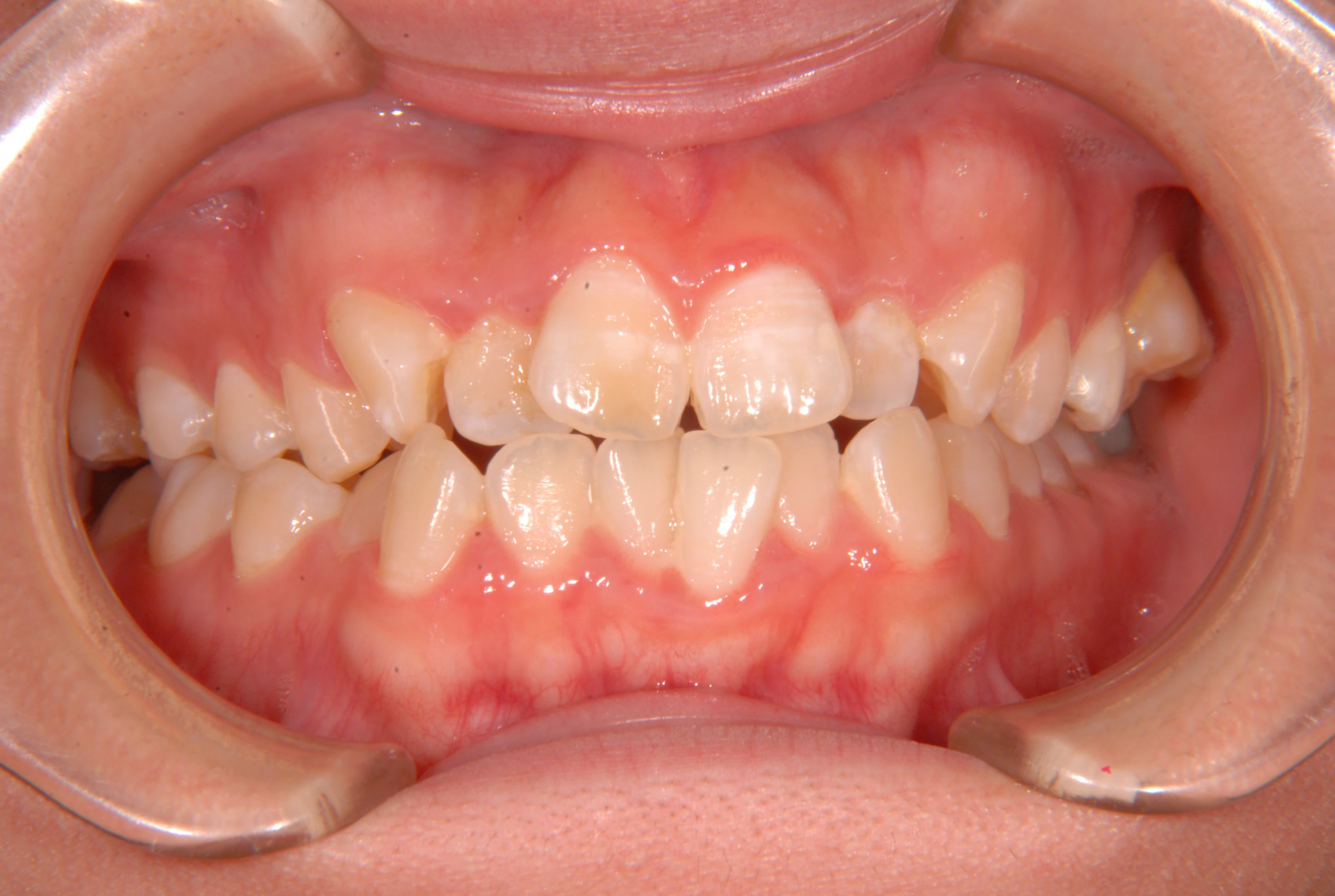 変なところから歯が生えている ガタガタ 噛みにくい22歳女性 N A様 京都さわだ矯正歯科