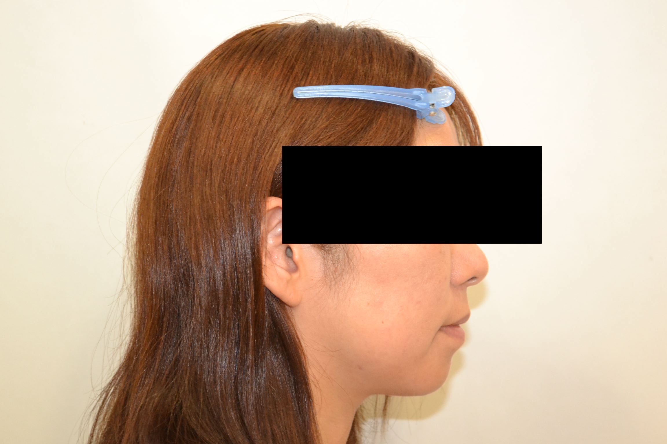 受け口・八重歯・ガタガタ・33歳女性【M.Y様】 京都さわだ矯正歯科