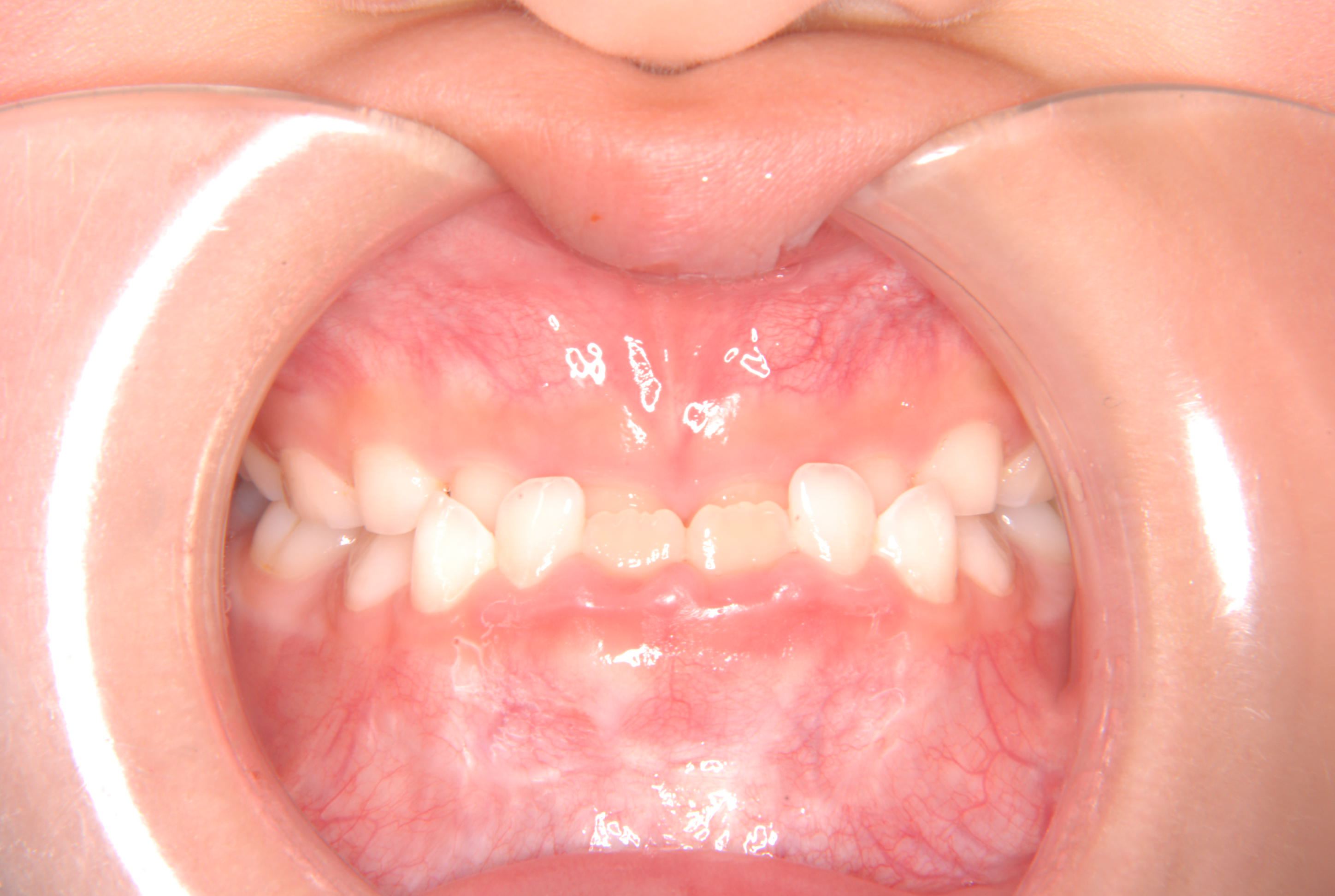 受け口・5歳女児【M.F様】｜京都 長岡京市 向日市 島本町｜矯正歯科