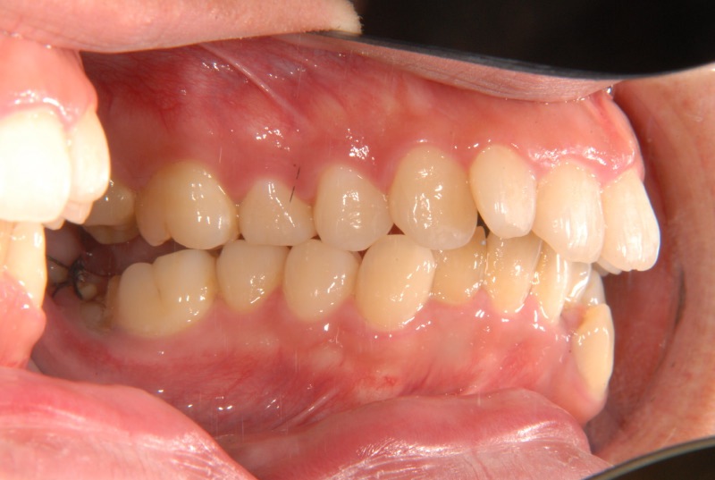 がたがた・埋伏歯・下の歯が1本飛び出している・32歳女性【E.M様】 京都さわだ矯正歯科