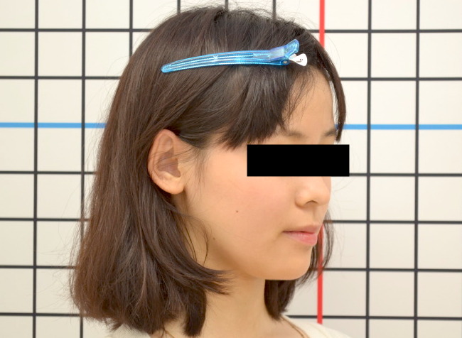 顎変形症 受け口 顎のゆがみ 18歳女性 Y F様 京都さわだ矯正歯科