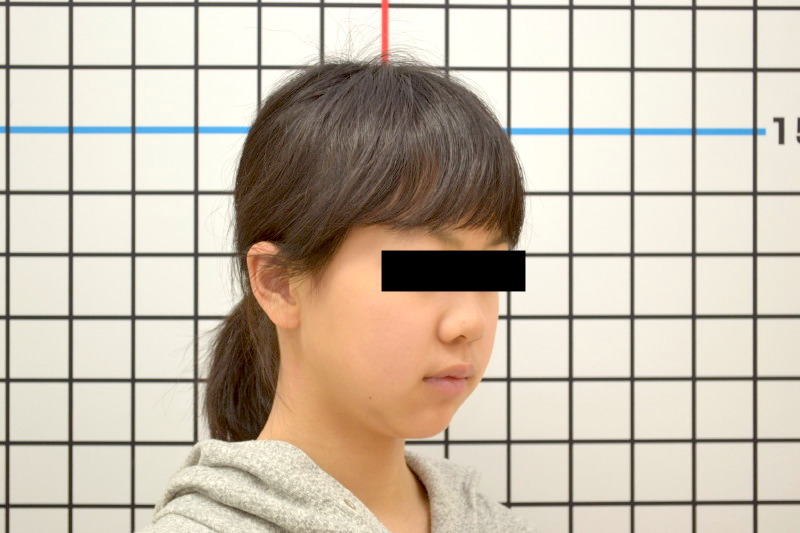 八重歯・ガタガタ・11歳女児【T.S様】 京都さわだ矯正歯科