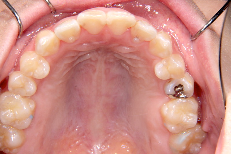 変なところから歯が生えている ガタガタ 噛みにくい22歳女性 N A様 京都さわだ矯正歯科