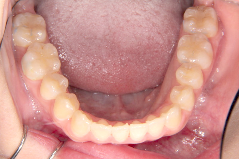 変なところから歯が生えている ガタガタ 噛みにくい22歳女性 N A様 京都さわだ矯正歯科