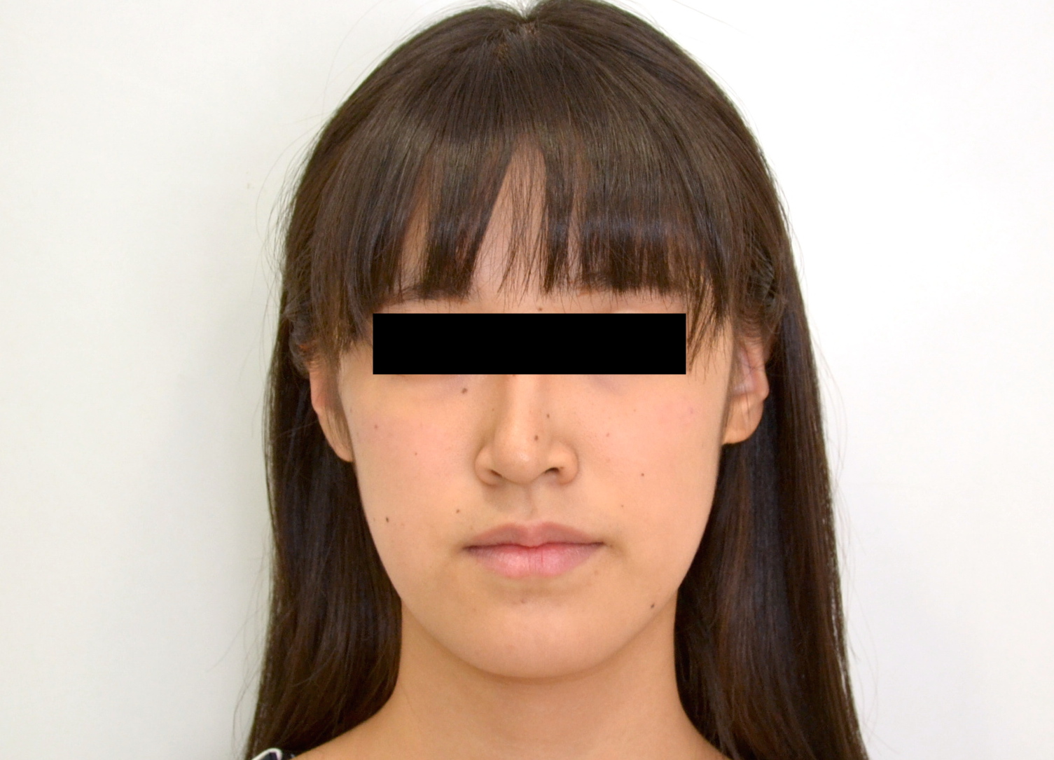 切端咬合 噛み合わず真ん中がずれている 17歳女性 C K様 京都さわだ矯正歯科