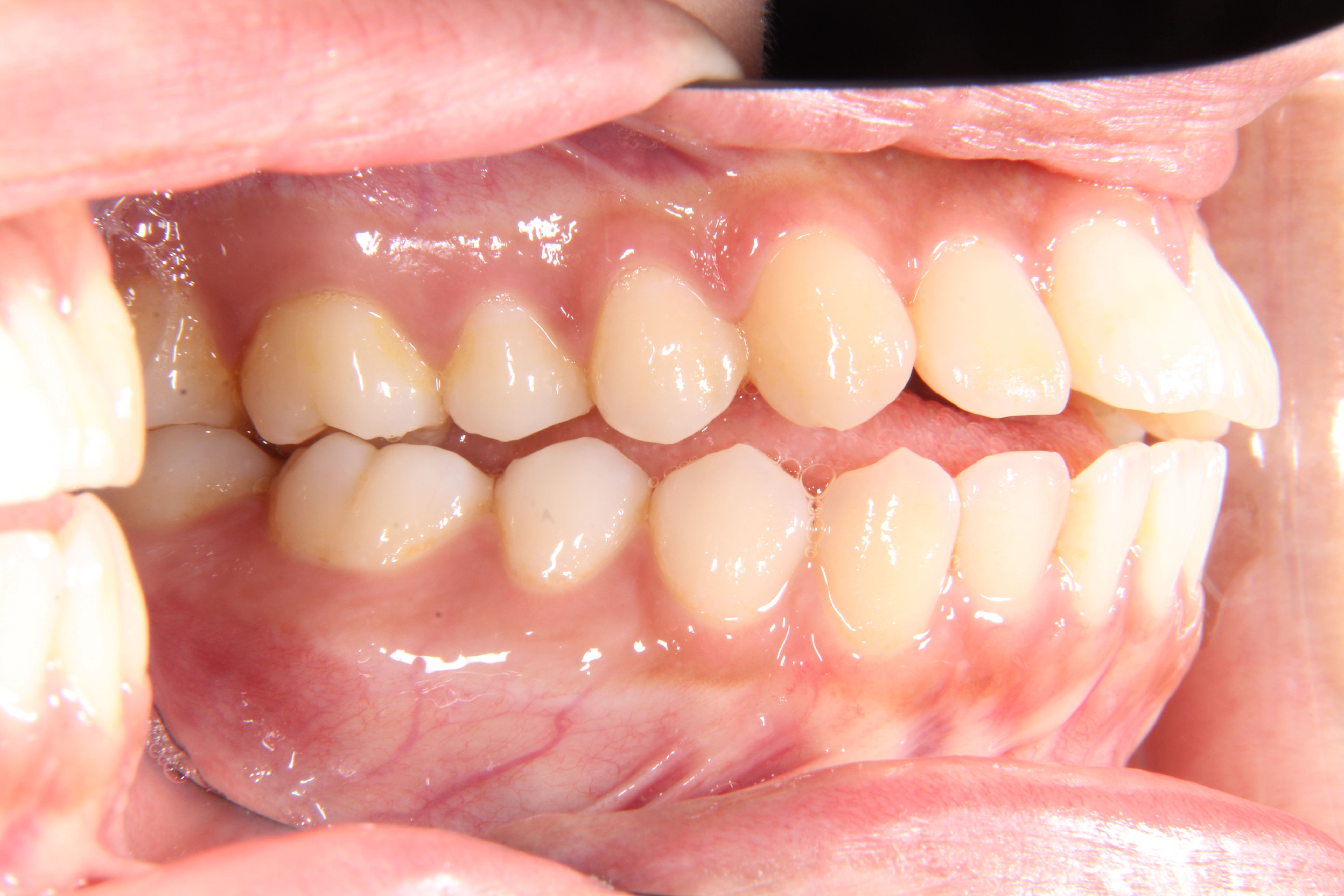 舌 歯並び 滑 歯科矯正中の違和感は？滑舌が悪くなるのか