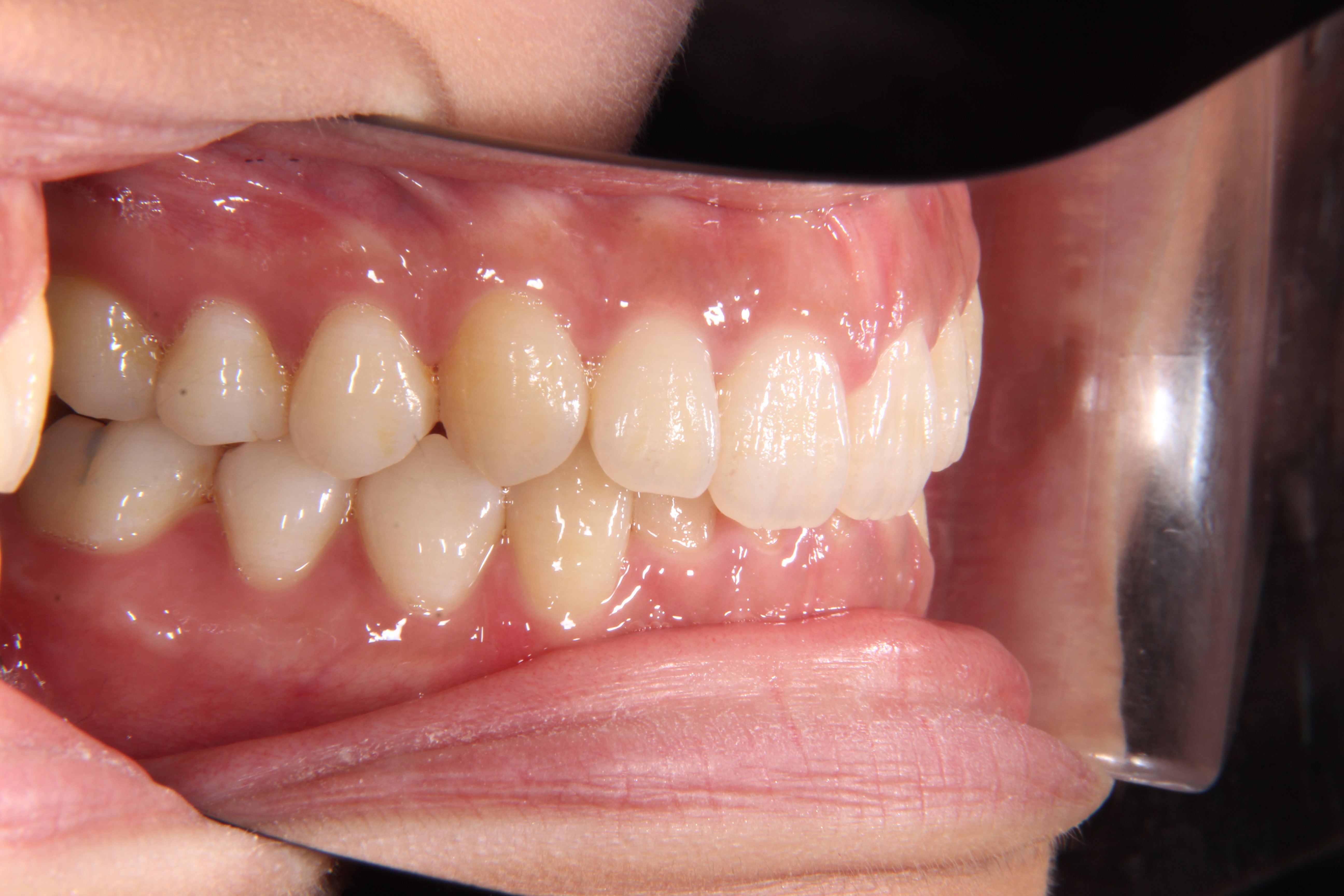 舌 歯並び 滑 歯並びが悪いと滑舌にも影響する？専門医が詳しく解説します