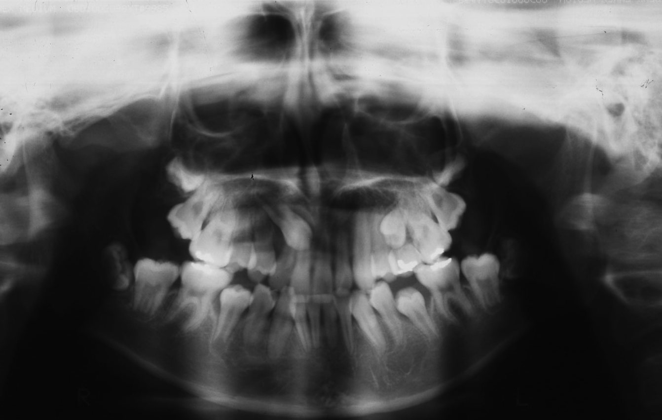 埋伏歯の矯正治療例一覧 京都 さわだ矯正歯科